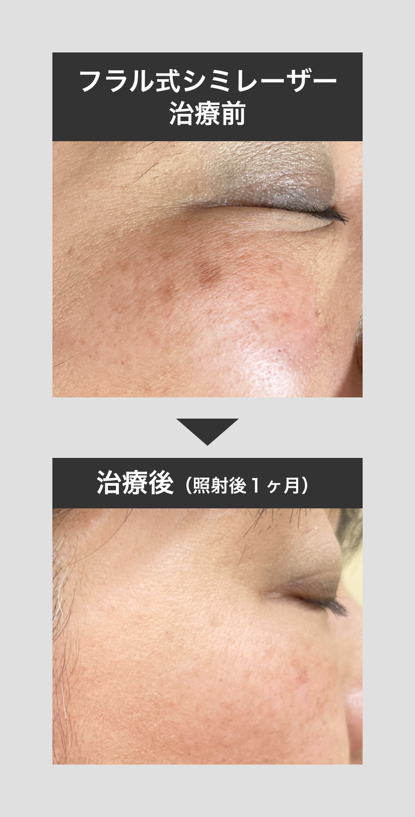 シミの治療 |本 | 通販 | Amazon
